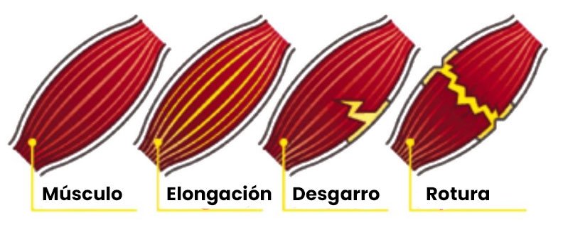 Desgarro muscular, rotura y distensión