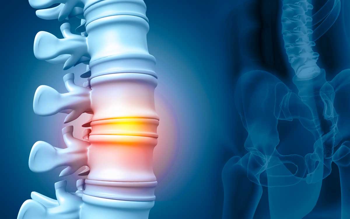 Qué es una hernia discal